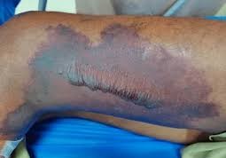 Necrotizing Fasciitis (Inflammation of Skin)